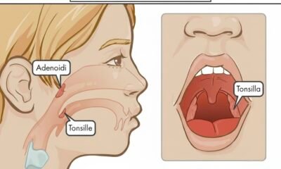 Adenoidid: Causes, Symptoms, Diagnosis, and Treatment Explained
